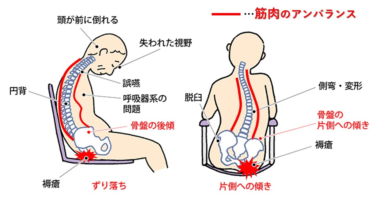 脳梗塞_しびれの原因とリハビリ