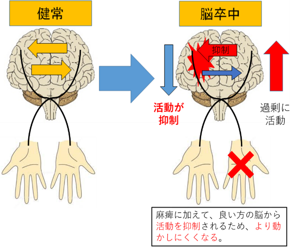 脳 梗塞 左 半身 麻痺