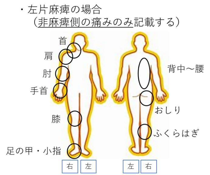 脳梗塞後遺症