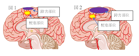 脳梗塞の症状