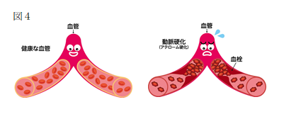 動脈硬化によって、血管の内側に脂肪（コレステロールなど）のドロドロとした物質がこびり付いて溜まってしまった状態