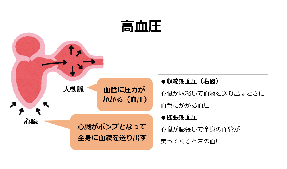 脳梗塞の危険因子_高血圧