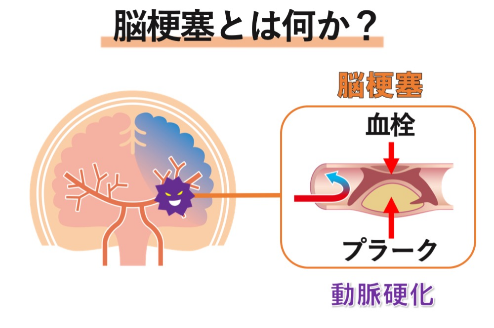 脳梗塞とは？症状と原因を脳梗塞リハビリBOTスタッフが解説