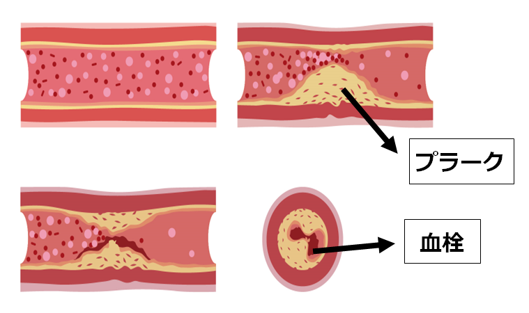 動脈硬化