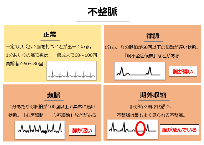 脳梗塞の危険因子_不整脈