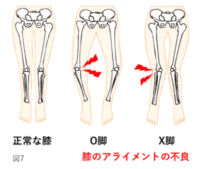 膝関節の変形