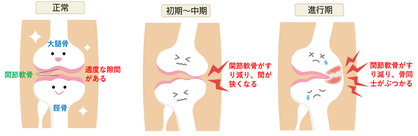 変形性膝関節症の症状の経過