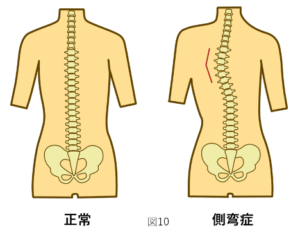 正常な腰と側彎症の腰