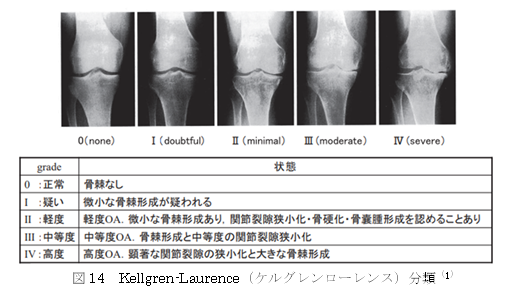 変形性膝関節症のレントゲン検査