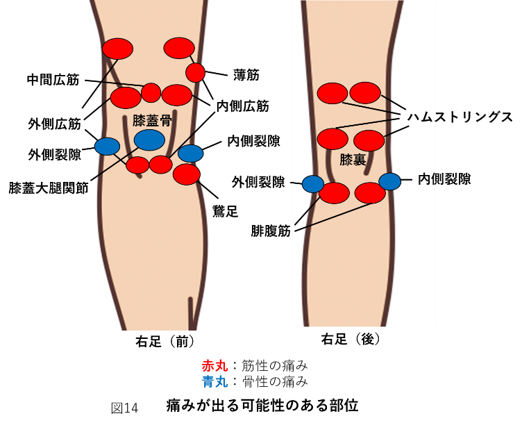 変形性膝関節症で痛みが出る可能性がある部位