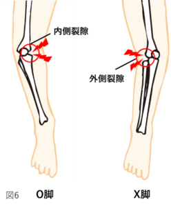 変形性膝関節症の痛み