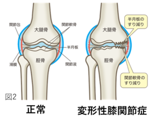 変形性膝関節症