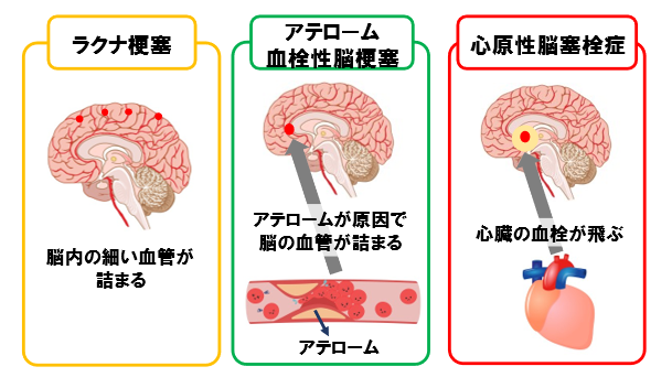 脳梗塞とは