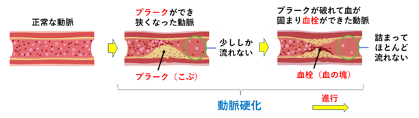 動脈硬化