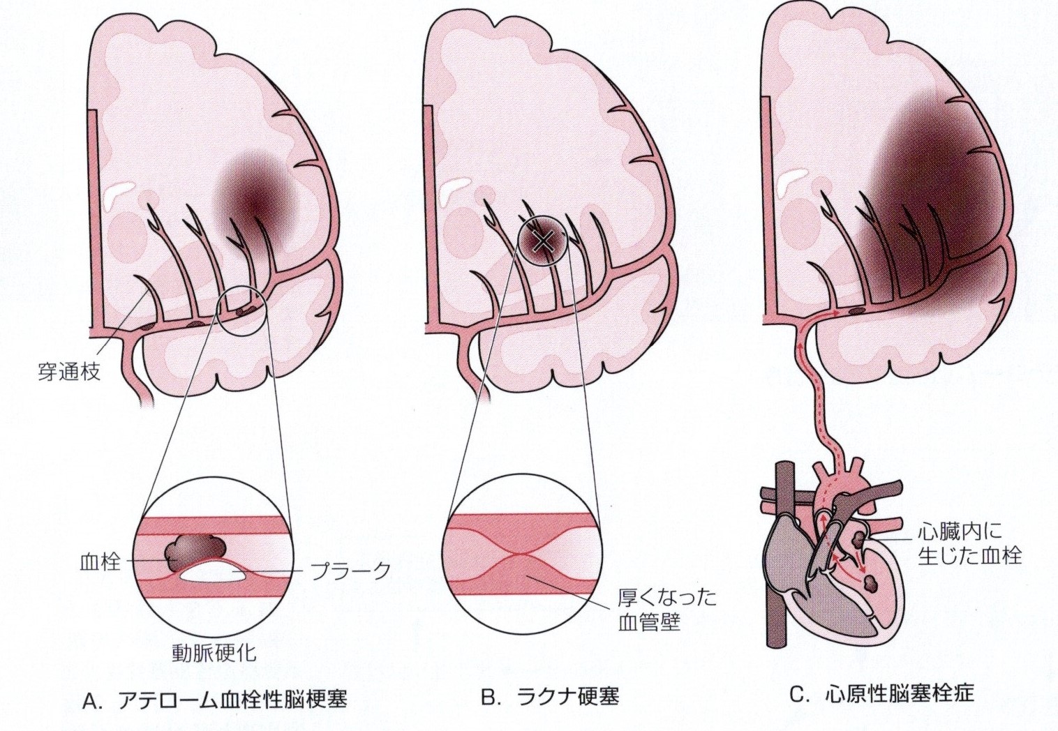 脳梗塞の３つの病気のタイプ