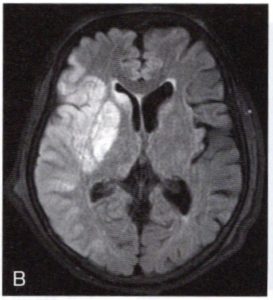右中大脳動脈の脳梗塞の脳画像の例