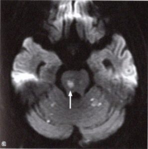 右脳底大脳動脈の脳梗塞の脳画像の例