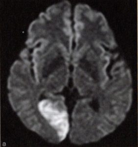 右後大脳動脈の脳梗塞の脳画像の例
