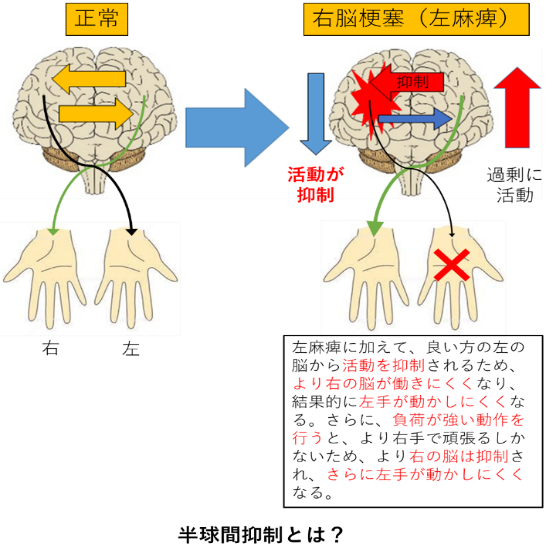 半球間抑制