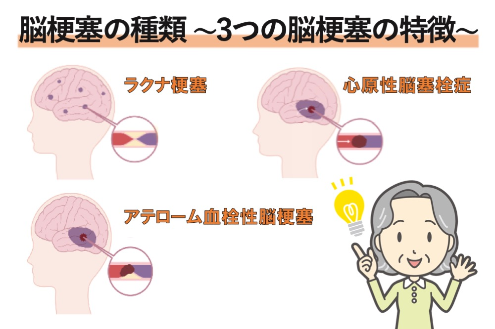 脳梗塞の種類～3つの特徴～