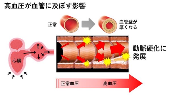 高血圧が及ぼす影響